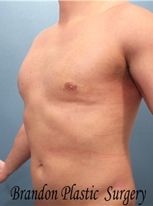 Male Breast Reduction After Photo by Marvin Shienbaum, MD; Brandon, FL - Case 34847