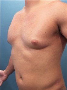 Male Breast Reduction Before Photo by Marvin Shienbaum, MD; Brandon, FL - Case 34847