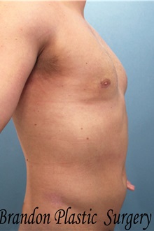 Male Breast Reduction After Photo by Marvin Shienbaum, MD; Brandon, FL - Case 34847