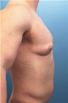 Male Breast Reduction Before Photo by Marvin Shienbaum, MD; Brandon, FL - Case 34847