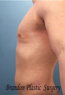 Male Breast Reduction After Photo by Marvin Shienbaum, MD; Brandon, FL - Case 34847