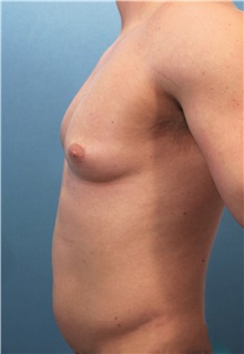 Male Breast Reduction Before Photo by Marvin Shienbaum, MD; Brandon, FL - Case 34847