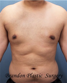 Male Breast Reduction After Photo by Marvin Shienbaum, MD; Brandon, FL - Case 34849