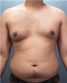 Male Breast Reduction Before Photo by Marvin Shienbaum, MD; Brandon, FL - Case 34849