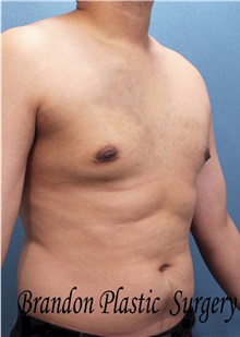 Male Breast Reduction After Photo by Marvin Shienbaum, MD; Brandon, FL - Case 34849