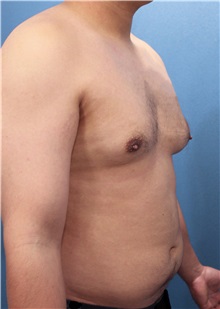 Male Breast Reduction Before Photo by Marvin Shienbaum, MD; Brandon, FL - Case 34849