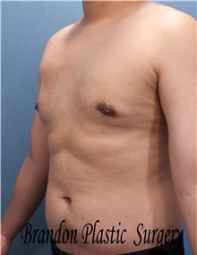 Male Breast Reduction After Photo by Marvin Shienbaum, MD; Brandon, FL - Case 34849