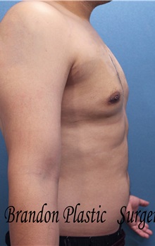 Male Breast Reduction After Photo by Marvin Shienbaum, MD; Brandon, FL - Case 34849