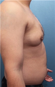 Male Breast Reduction Before Photo by Marvin Shienbaum, MD; Brandon, FL - Case 34849