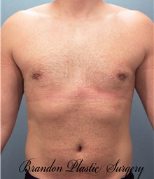 Male Breast Reduction After Photo by Marvin Shienbaum, MD; Brandon, FL - Case 34850