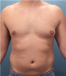 Male Breast Reduction Before Photo by Marvin Shienbaum, MD; Brandon, FL - Case 34850