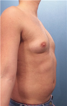 Male Breast Reduction Before Photo by Marvin Shienbaum, MD; Brandon, FL - Case 34850