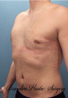 Male Breast Reduction After Photo by Marvin Shienbaum, MD; Brandon, FL - Case 34850