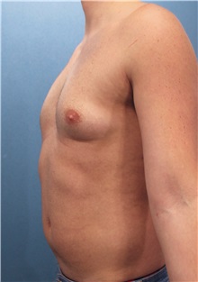 Male Breast Reduction Before Photo by Marvin Shienbaum, MD; Brandon, FL - Case 34850