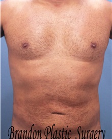 Male Breast Reduction After Photo by Marvin Shienbaum, MD; Brandon, FL - Case 34852