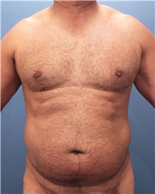 Male Breast Reduction Before Photo by Marvin Shienbaum, MD; Brandon, FL - Case 34852