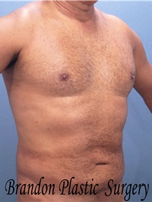 Male Breast Reduction After Photo by Marvin Shienbaum, MD; Brandon, FL - Case 34852