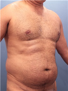 Male Breast Reduction Before Photo by Marvin Shienbaum, MD; Brandon, FL - Case 34852