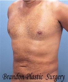 Male Breast Reduction After Photo by Marvin Shienbaum, MD; Brandon, FL - Case 34852