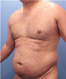 Male Breast Reduction Before Photo by Marvin Shienbaum, MD; Brandon, FL - Case 34852