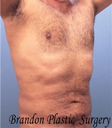 Male Breast Reduction After Photo by Marvin Shienbaum, MD; Brandon, FL - Case 34852