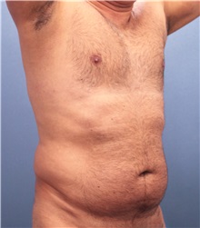 Male Breast Reduction Before Photo by Marvin Shienbaum, MD; Brandon, FL - Case 34852