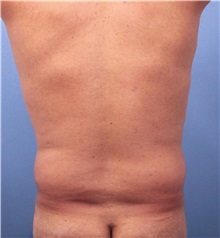 Male Breast Reduction Before Photo by Marvin Shienbaum, MD; Brandon, FL - Case 34852