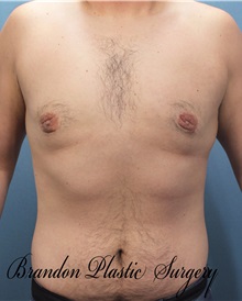 Male Breast Reduction After Photo by Marvin Shienbaum, MD; Brandon, FL - Case 34854