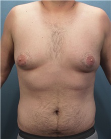 Male Breast Reduction Before Photo by Marvin Shienbaum, MD; Brandon, FL - Case 34854