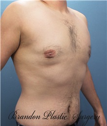 Male Breast Reduction After Photo by Marvin Shienbaum, MD; Brandon, FL - Case 34854