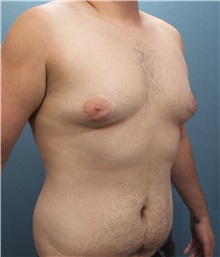 Male Breast Reduction Before Photo by Marvin Shienbaum, MD; Brandon, FL - Case 34854