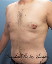 Male Breast Reduction After Photo by Marvin Shienbaum, MD; Brandon, FL - Case 34854