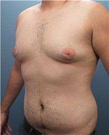 Male Breast Reduction Before Photo by Marvin Shienbaum, MD; Brandon, FL - Case 34854