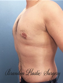 Male Breast Reduction After Photo by Marvin Shienbaum, MD; Brandon, FL - Case 34854