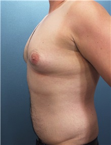 Male Breast Reduction Before Photo by Marvin Shienbaum, MD; Brandon, FL - Case 34854