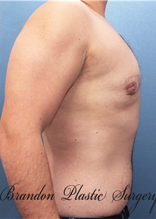 Male Breast Reduction After Photo by Marvin Shienbaum, MD; Brandon, FL - Case 34854