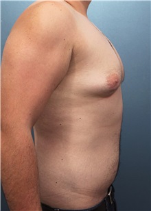 Male Breast Reduction Before Photo by Marvin Shienbaum, MD; Brandon, FL - Case 34854