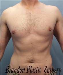 Male Breast Reduction After Photo by Marvin Shienbaum, MD; Brandon, FL - Case 34855