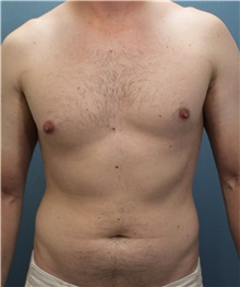 Male Breast Reduction Before Photo by Marvin Shienbaum, MD; Brandon, FL - Case 34855