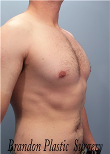 Male Breast Reduction After Photo by Marvin Shienbaum, MD; Brandon, FL - Case 34855