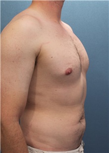 Male Breast Reduction Before Photo by Marvin Shienbaum, MD; Brandon, FL - Case 34855