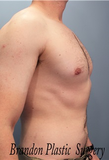 Male Breast Reduction After Photo by Marvin Shienbaum, MD; Brandon, FL - Case 34855