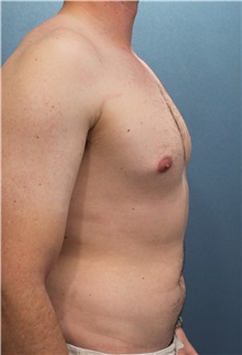 Male Breast Reduction Before Photo by Marvin Shienbaum, MD; Brandon, FL - Case 34855