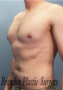 Male Breast Reduction After Photo by Marvin Shienbaum, MD; Brandon, FL - Case 34855