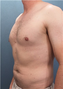 Male Breast Reduction Before Photo by Marvin Shienbaum, MD; Brandon, FL - Case 34855