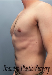 Male Breast Reduction After Photo by Marvin Shienbaum, MD; Brandon, FL - Case 34855