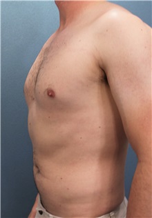 Male Breast Reduction Before Photo by Marvin Shienbaum, MD; Brandon, FL - Case 34855