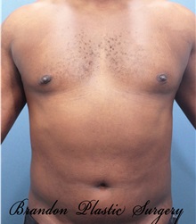 Male Breast Reduction After Photo by Marvin Shienbaum, MD; Brandon, FL - Case 34905