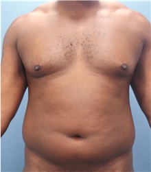 Male Breast Reduction Before Photo by Marvin Shienbaum, MD; Brandon, FL - Case 34905