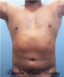 Male Breast Reduction After Photo by Marvin Shienbaum, MD; Brandon, FL - Case 34905